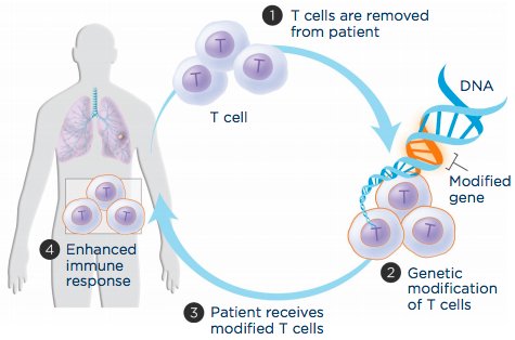 Adoptive T-cell transfer aims to boost a patient’s immune cells’ ability to recognize and attack cancer cells. (1) T cells are extracted from the patient’s blood, (2) genetically engineered to produce a molecule that recognizes cancer cells and grown in the laboratory, and (3) infused back into the patient to (4) improve immune response. (credit: LUNGevity Foundation)
