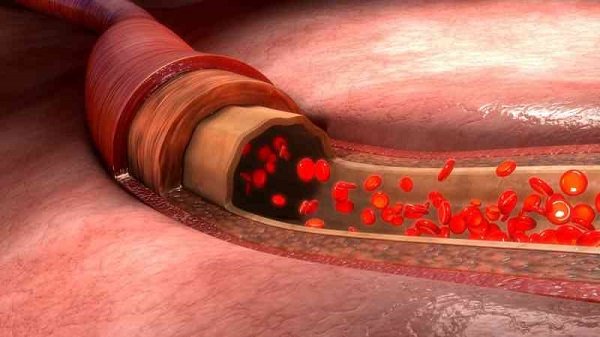 Fibromyalgia: The arteriole-venule shunts, which are responsible for heat regulation in our body.