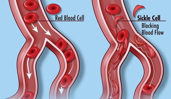 People with sickle cell anemia have red blood cells that are shaped like sickles, or crescent moons.