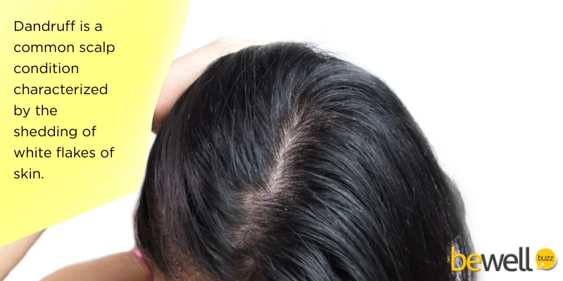 Dandruff is a common scalp condition characterized by the shedding of white flakes of skin.